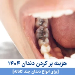 هزینه پر کردن دندان ۱۴۰۵ [برای انواع دندان چند کاناله]
