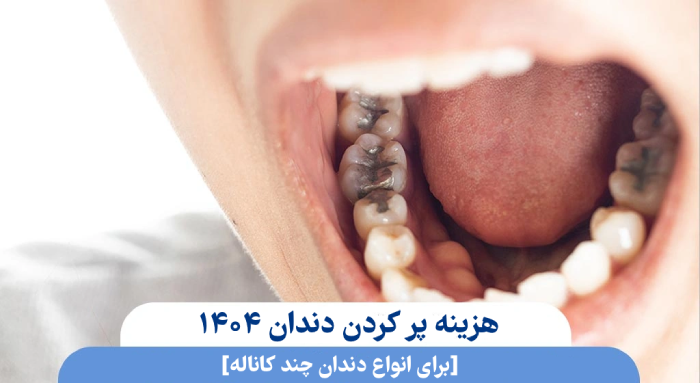 هزینه پر کردن دندان ۱۴۰۵ [برای انواع دندان چند کاناله]