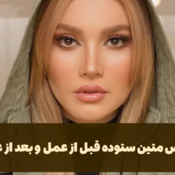 عکس متین ستوده قبل از عمل و بعد از عمل