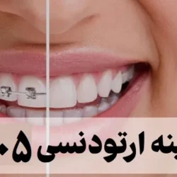 هزینه ارتودنسی ۱۴۰۵ [ لیست هزینه انواع ارتودنسی دندان ]