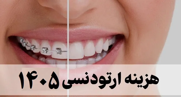 هزینه ارتودنسی ۱۴۰۵ [ لیست هزینه انواع ارتودنسی دندان ]