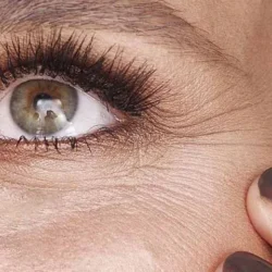 چگونه افتادگی گوشه چشم و شقیقه را با روش‌های نوین برطرف کنیم؟