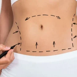 پیکرتراشی چیست و چه کسانی کاندید مناسبی هستند؟