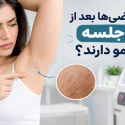 چرا بعضی‌ها بعد از ده جلسه هنوز مو دارند؟